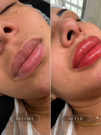 Lip Micropigmentation